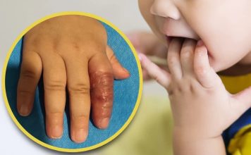 Cảnh báo nguy hiểm: Mẹo cai mút tay có thể đe dọa sức khỏe của trẻ