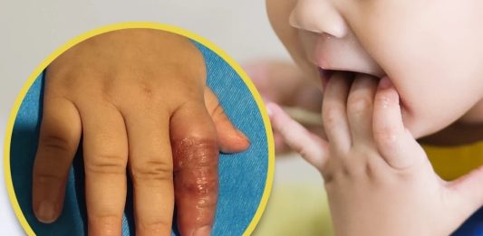 Cảnh báo nguy hiểm: Mẹo cai mút tay có thể đe dọa sức khỏe của trẻ