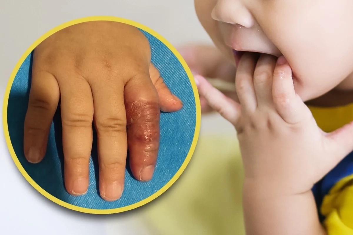 Mẹo cai mút tay có thể đe dọa sức khỏe của trẻ