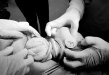 Bé gái chào đời đặc biệt với 6 vòng dây rốn quấn cổ: Hiện tượng hiếm gặp và những điều cần biết