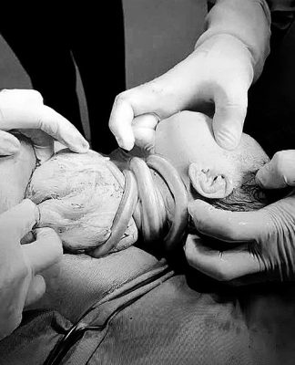 Bé gái chào đời đặc biệt với 6 vòng dây rốn quấn cổ: Hiện tượng hiếm gặp và những điều cần biết