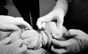 Bé gái chào đời đặc biệt với 6 vòng dây rốn quấn cổ: Hiện tượng hiếm gặp và những điều cần biết