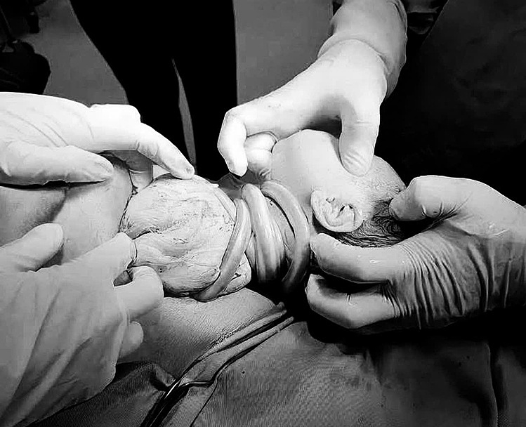 6 vòng dây rốn quấn cổ